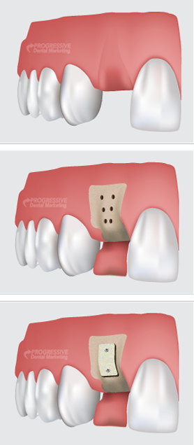 Dental Bone Grafts in Huntingburg, IN